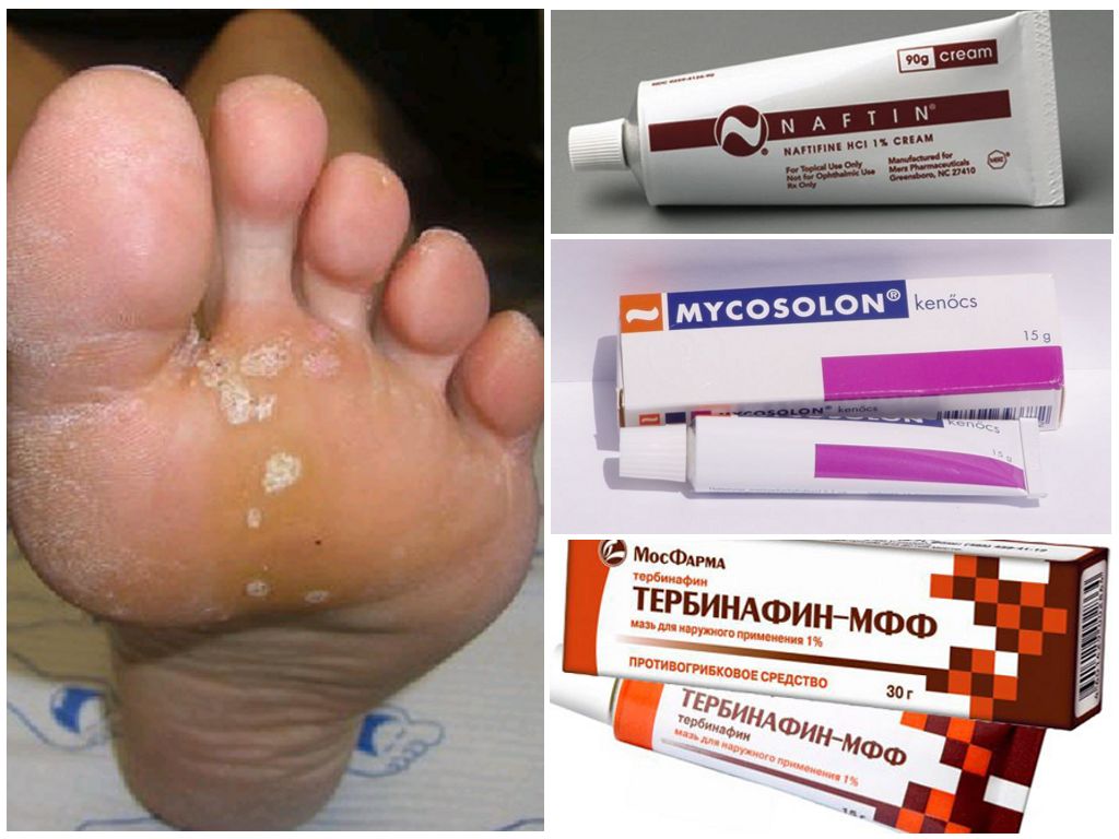 Мази против грибка стопы