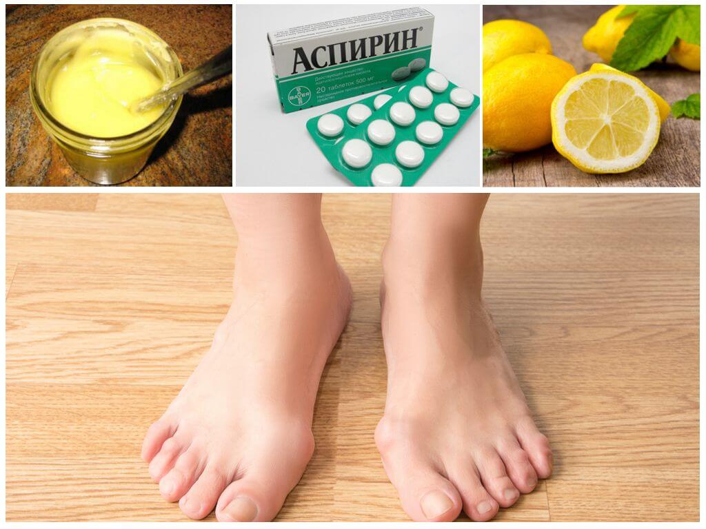 Мази от косточки на ноге