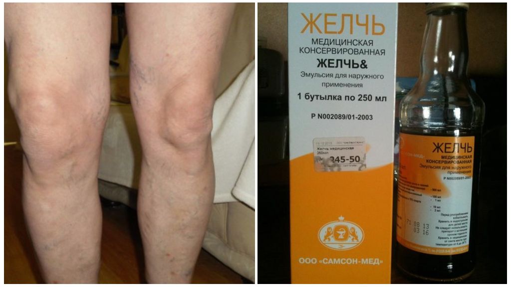 Медицинская желчь при артрозе коленного сустава