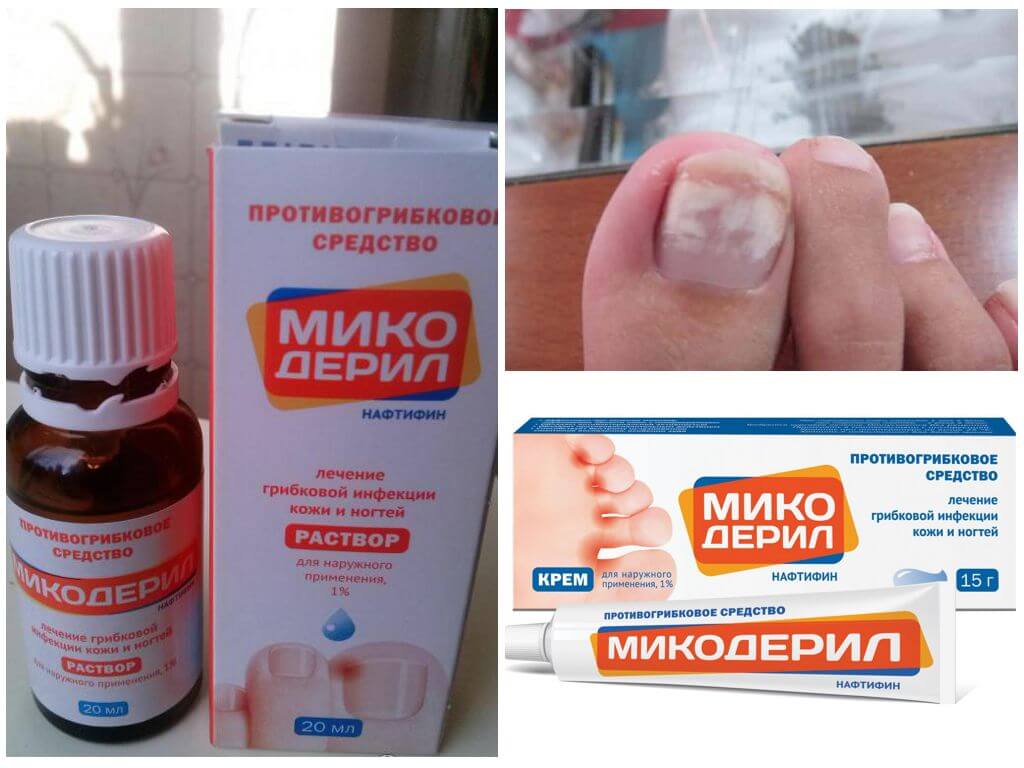 Микодерил для лечения грибковой инфекции