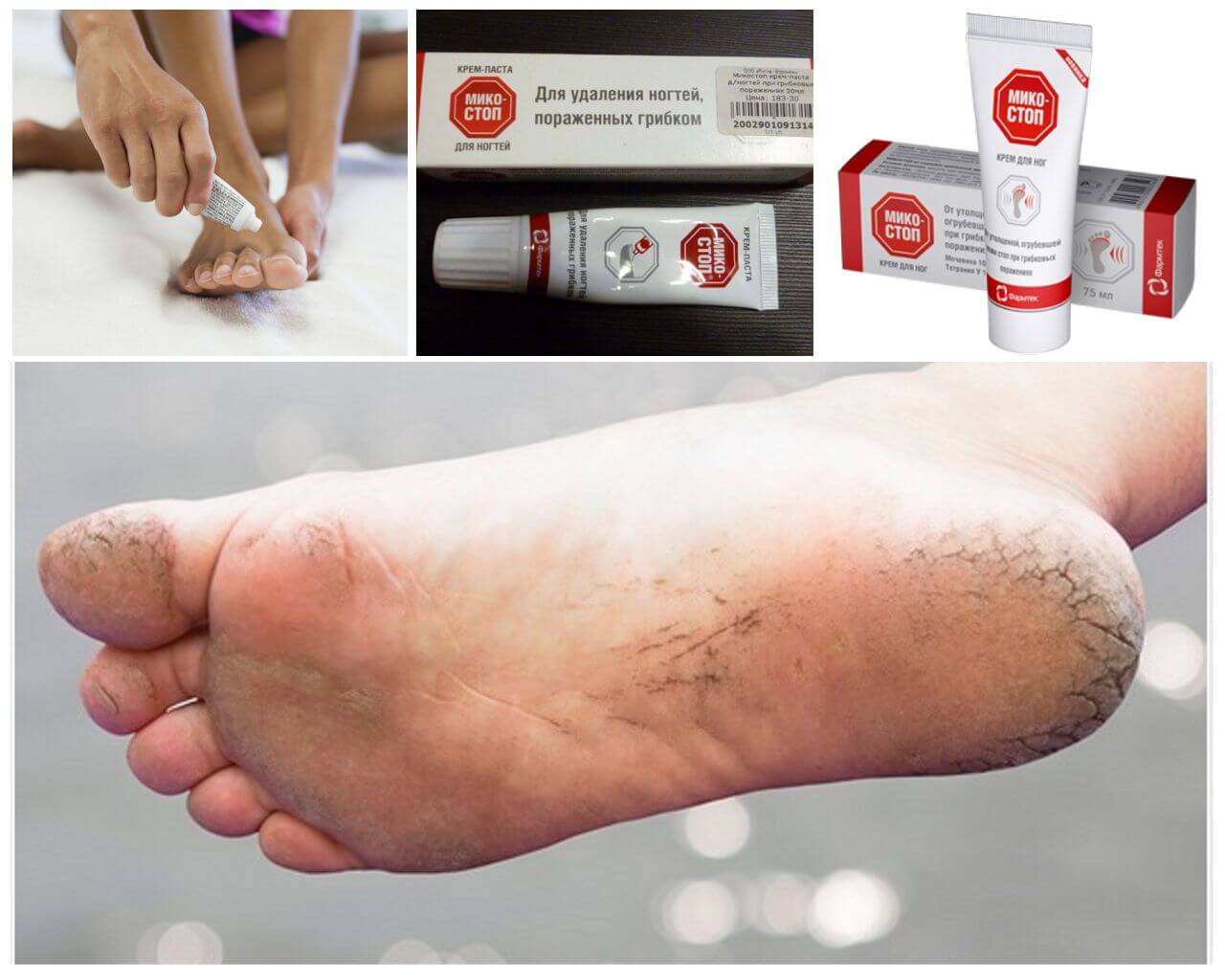 Средства Микостоп от грибка на ногах