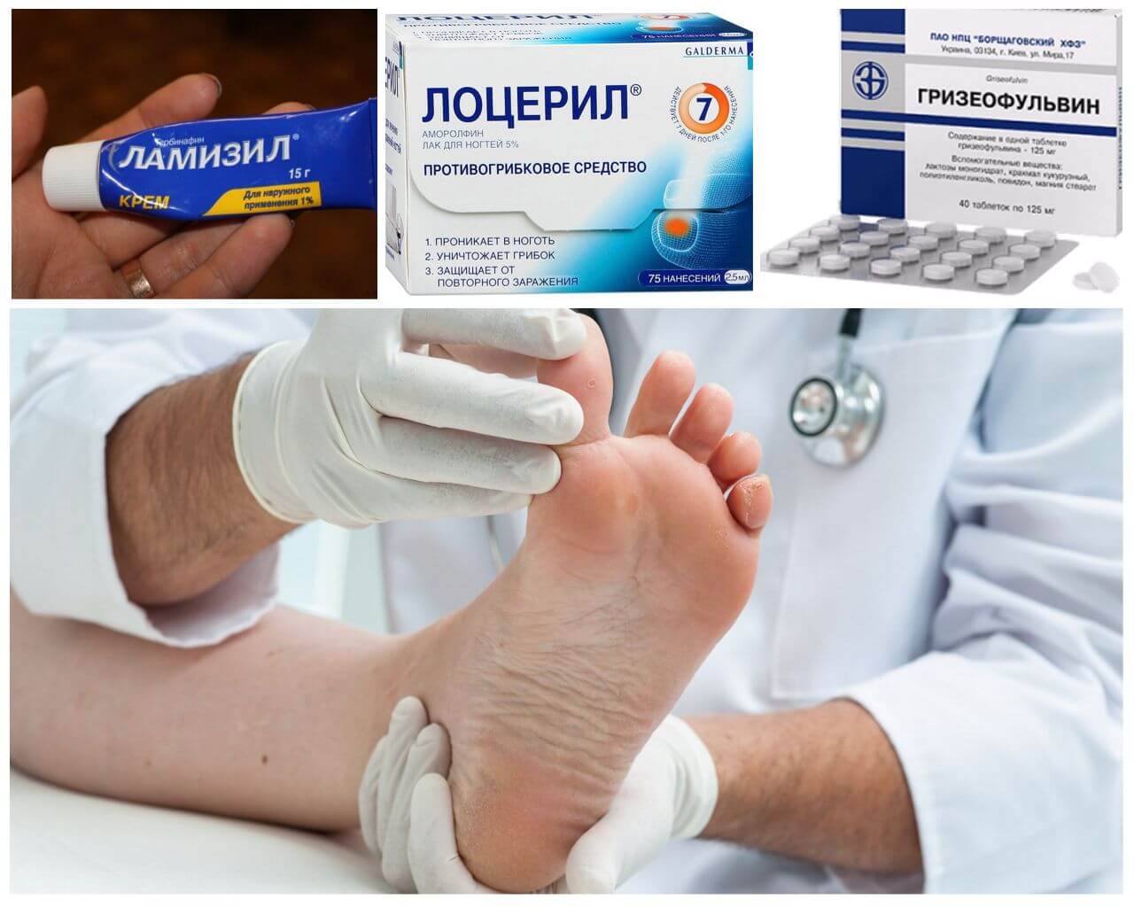 Лечение грибка на ногах