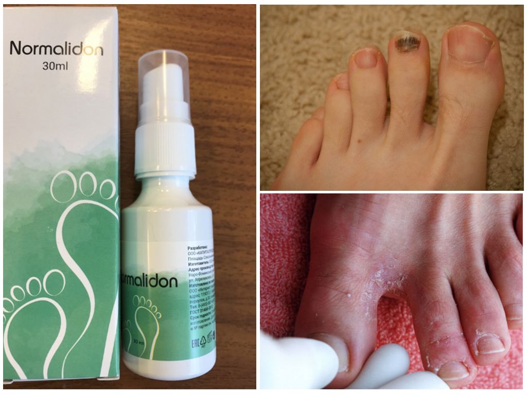 Средство Нормалидон от грибка ногтей