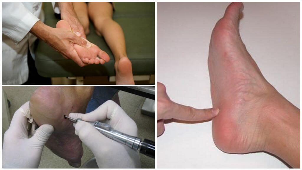 Операция при пяточной шпоре