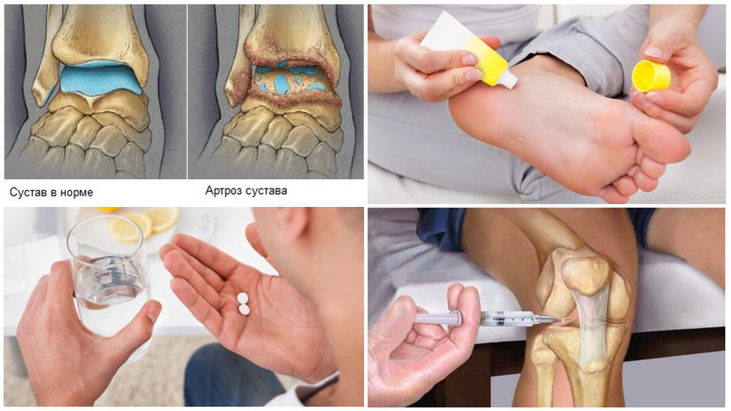 Лечение остеоартроза голеностопного сустава
