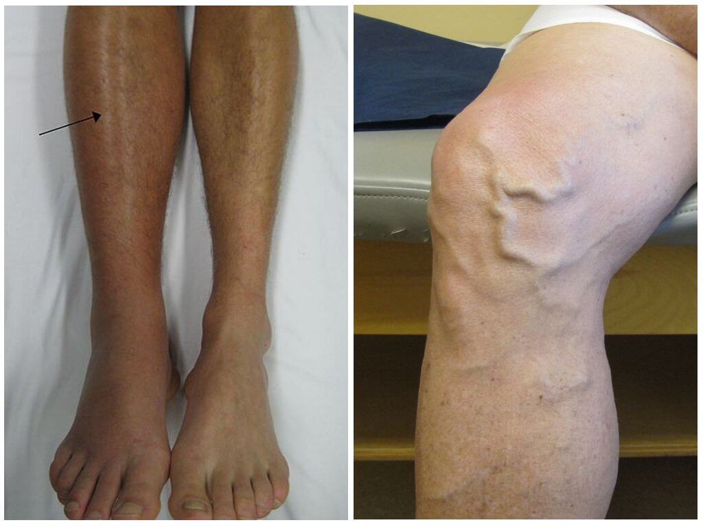 Отеки при варикозе