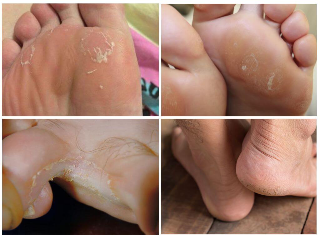 Признаки поражения ног грибковой инфекцией