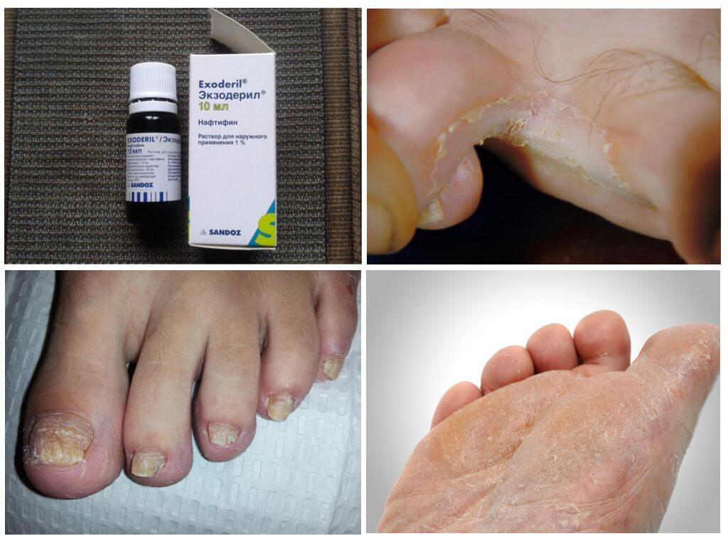 Показания к применению средств Экзодерил