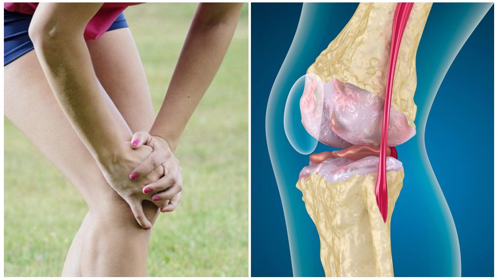 Пателлофеморальный артроз