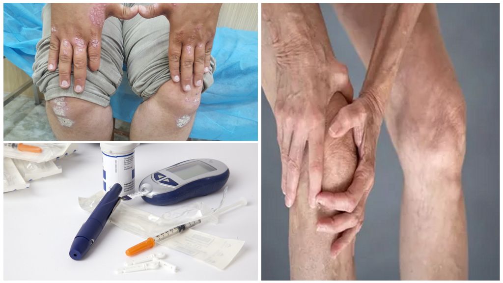 Причины артропатии