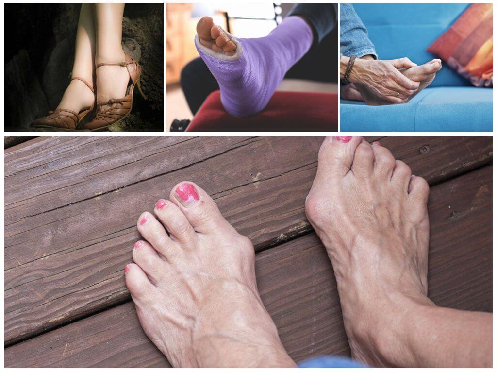 Причины появления косточек на ногах