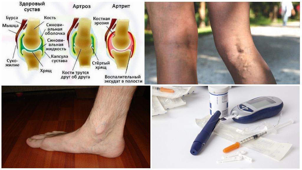 Артрозо артрит суставов