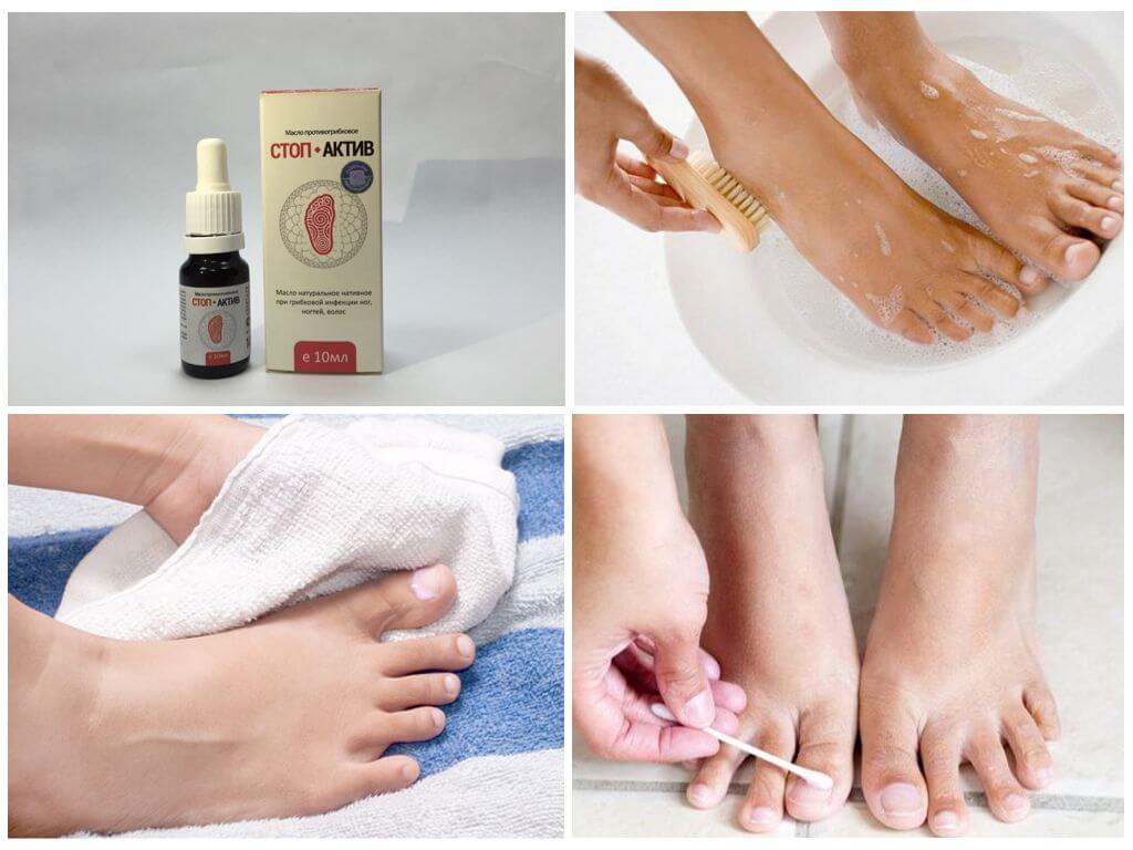 Применение масла при онихомикозе