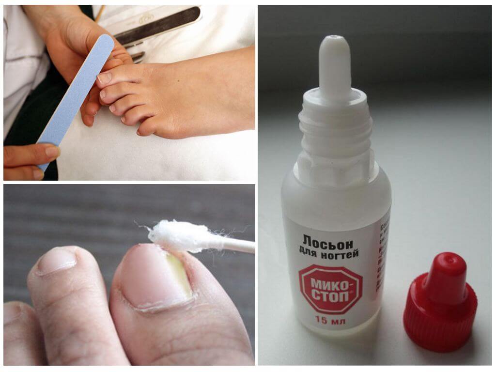 Применение лосьона Микостоп