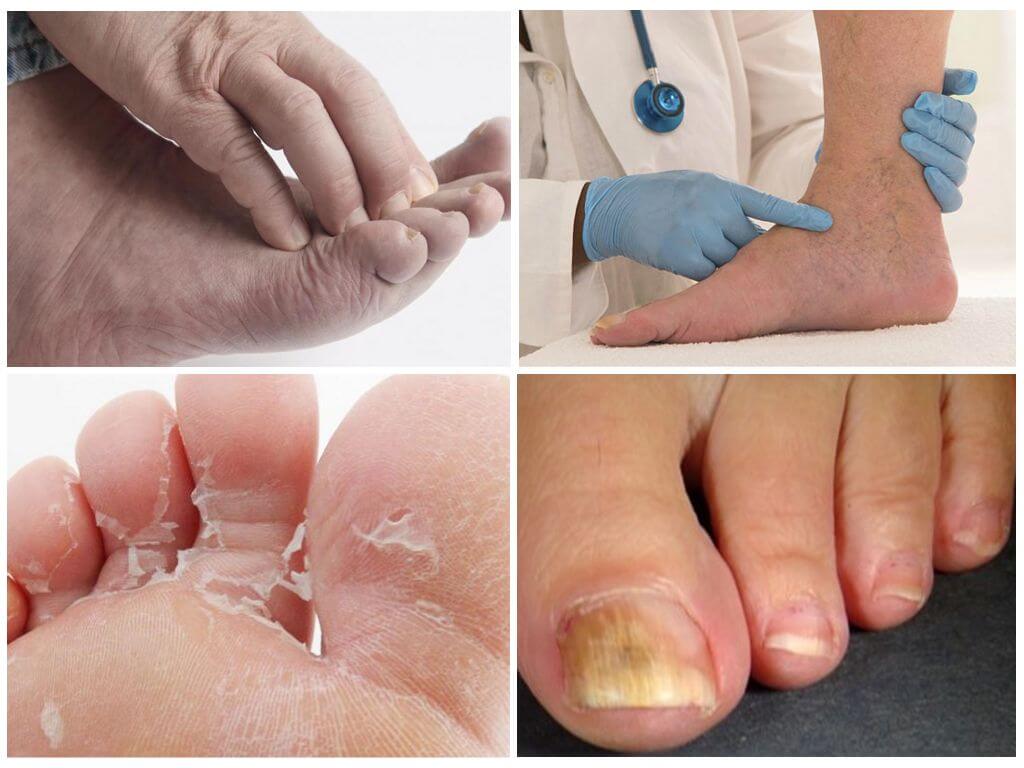 Признаки грибка на ногах