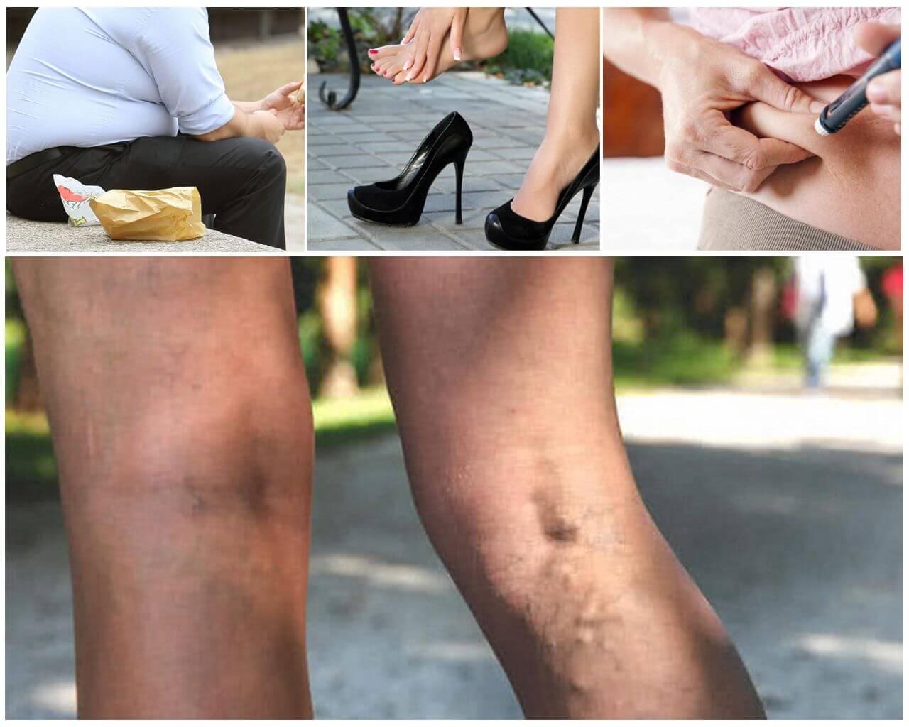 Признаки появления варикоза