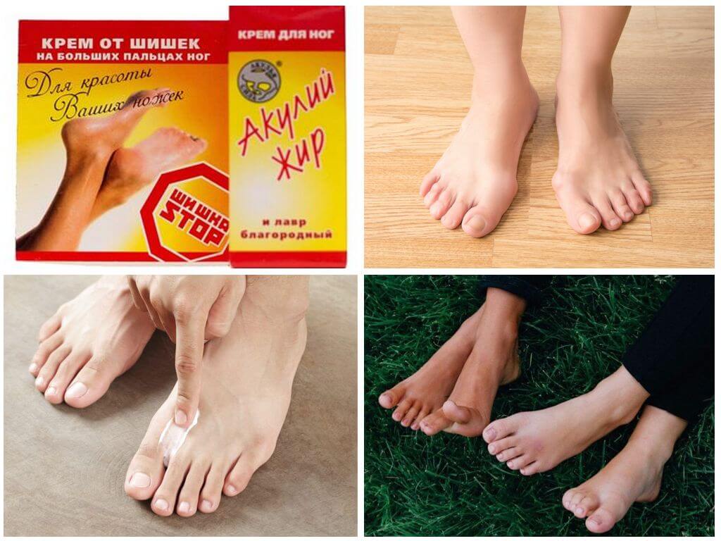 Применение крема Шишка Стоп