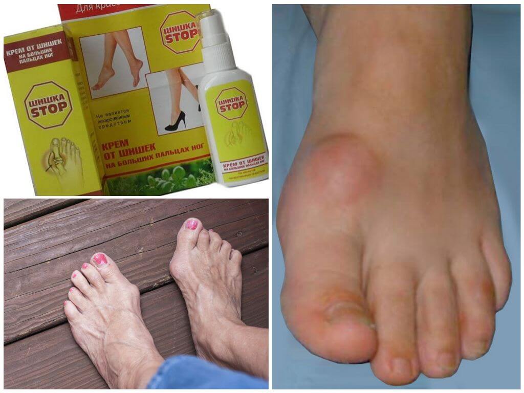 Крем Шишка Стоп от косточек на ноге
