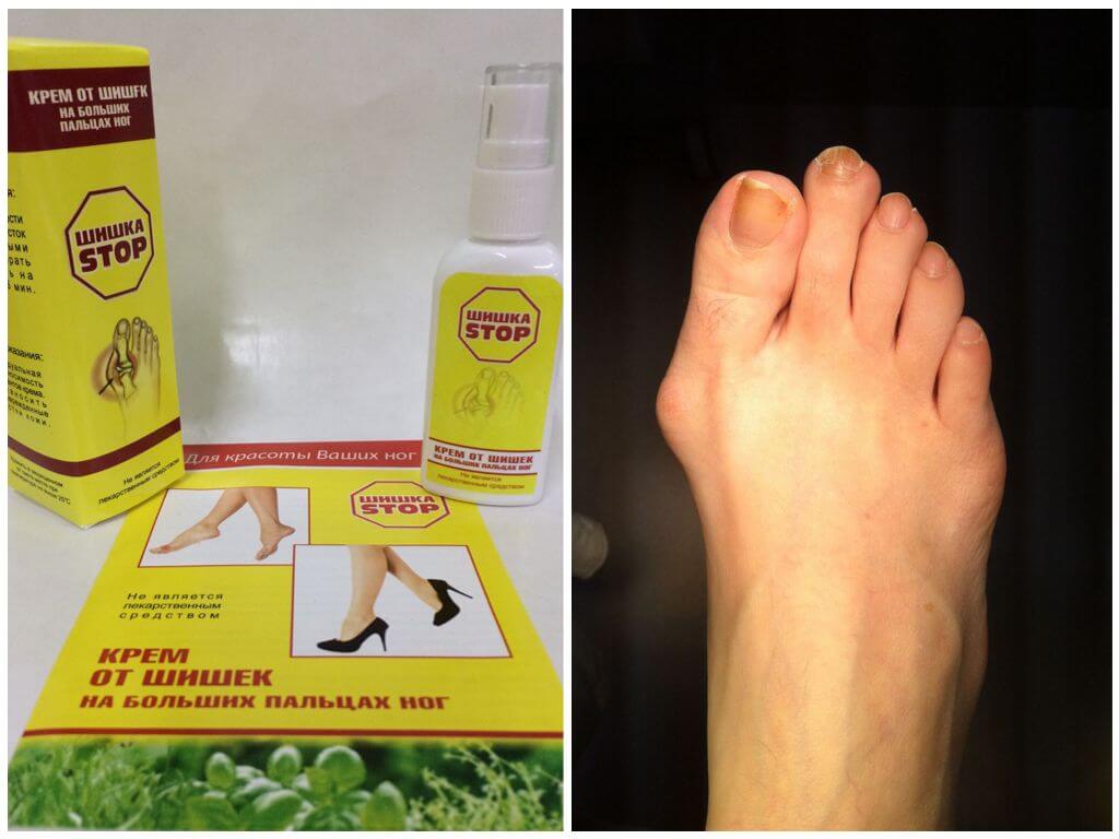 Крем Шишка Стоп от косточек на ногах