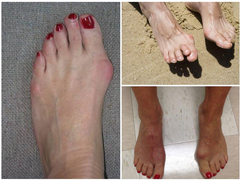 Косточки на ноге у большого пальца