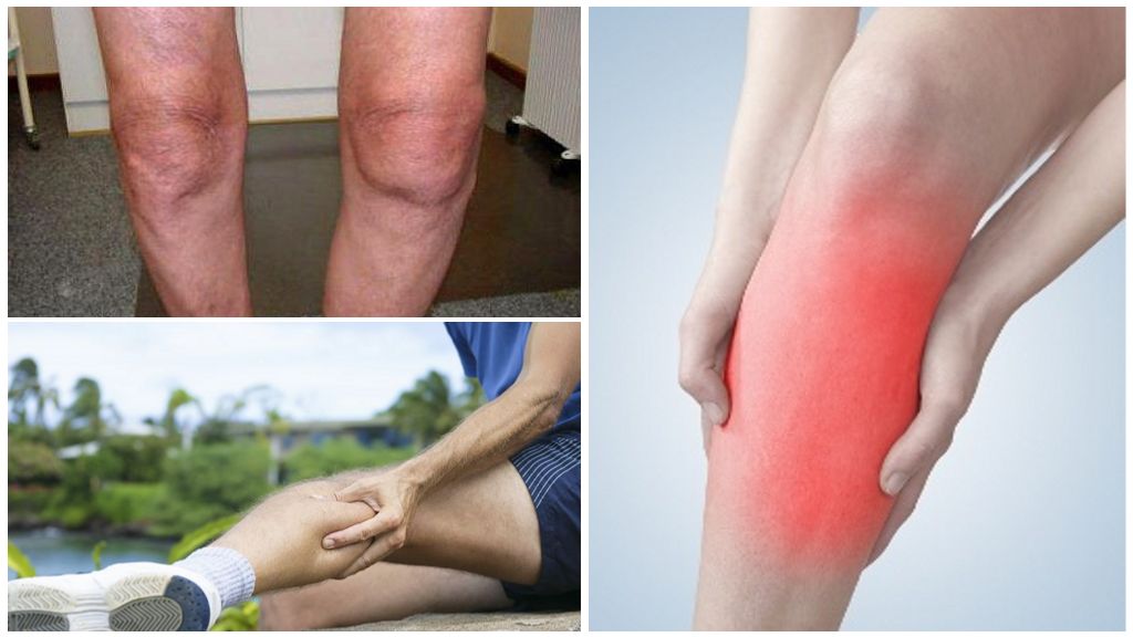 Симптомы артропатии суставов