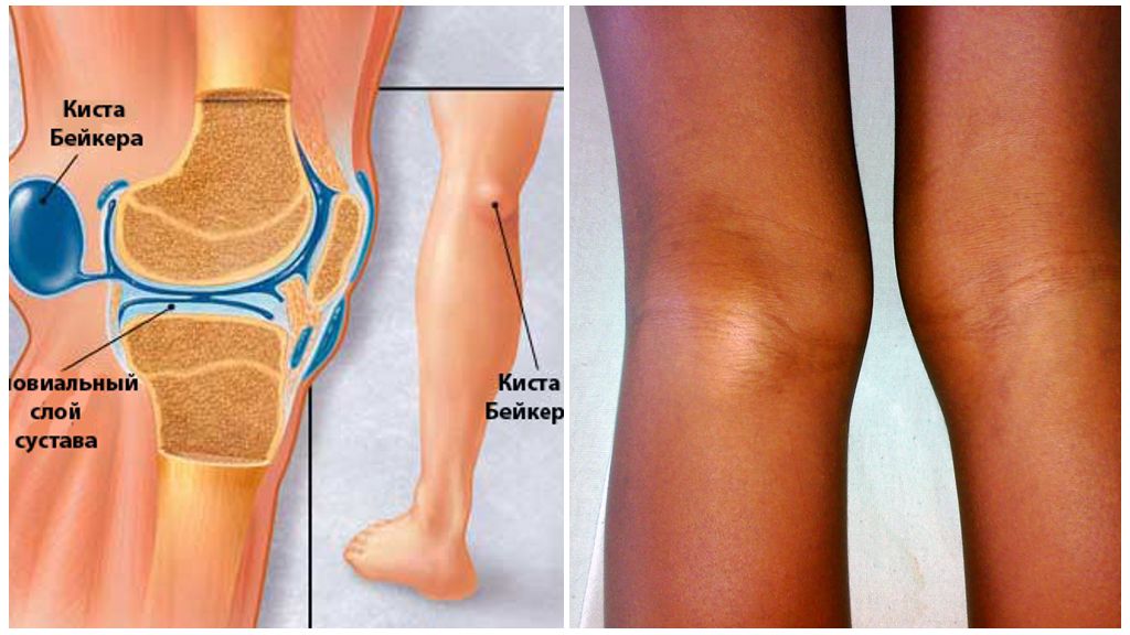 Синовиальная киста коленного сустава