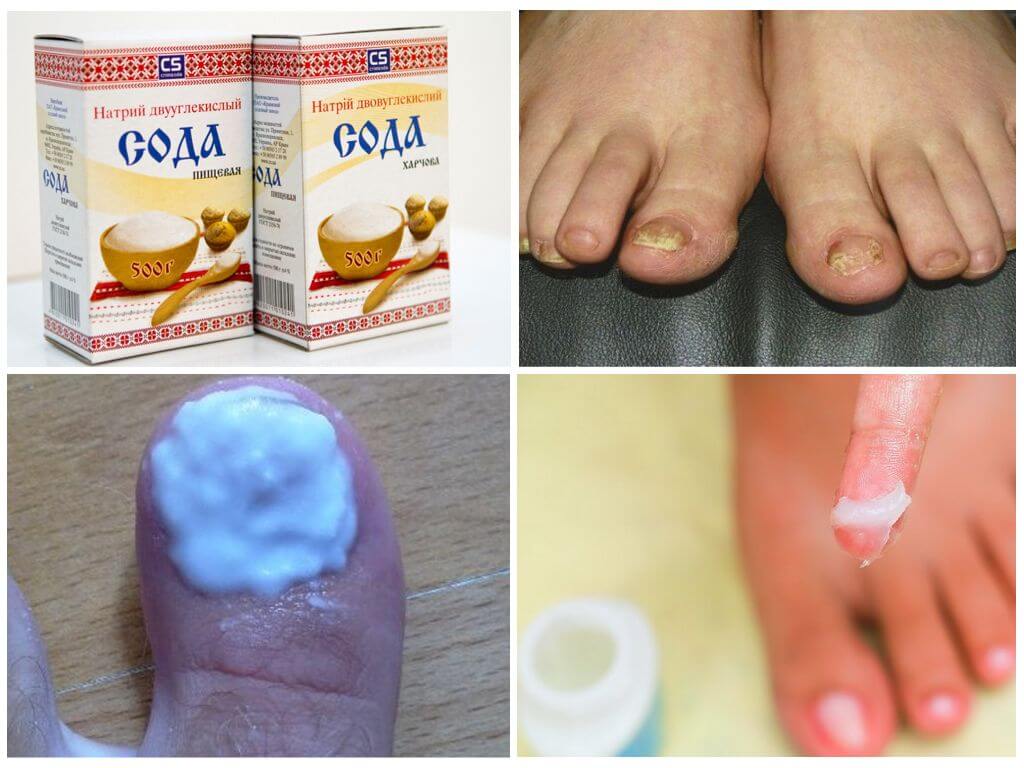 Смеси с содой для лечения грибка на ногах