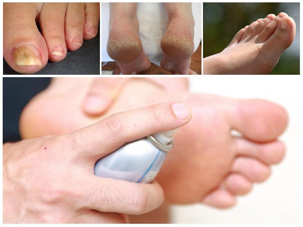 Спрей от грибка на ногах