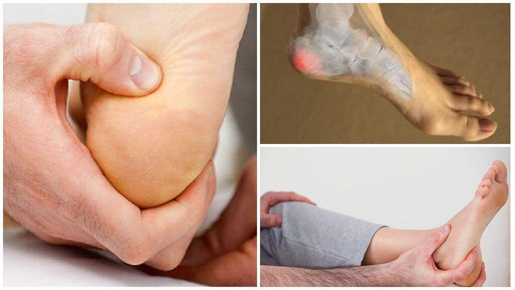 Шпора на пятке