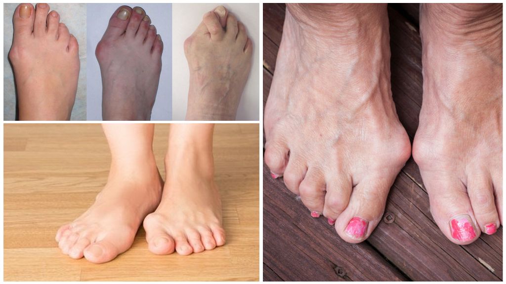 Артроз плюснефалангового сустава