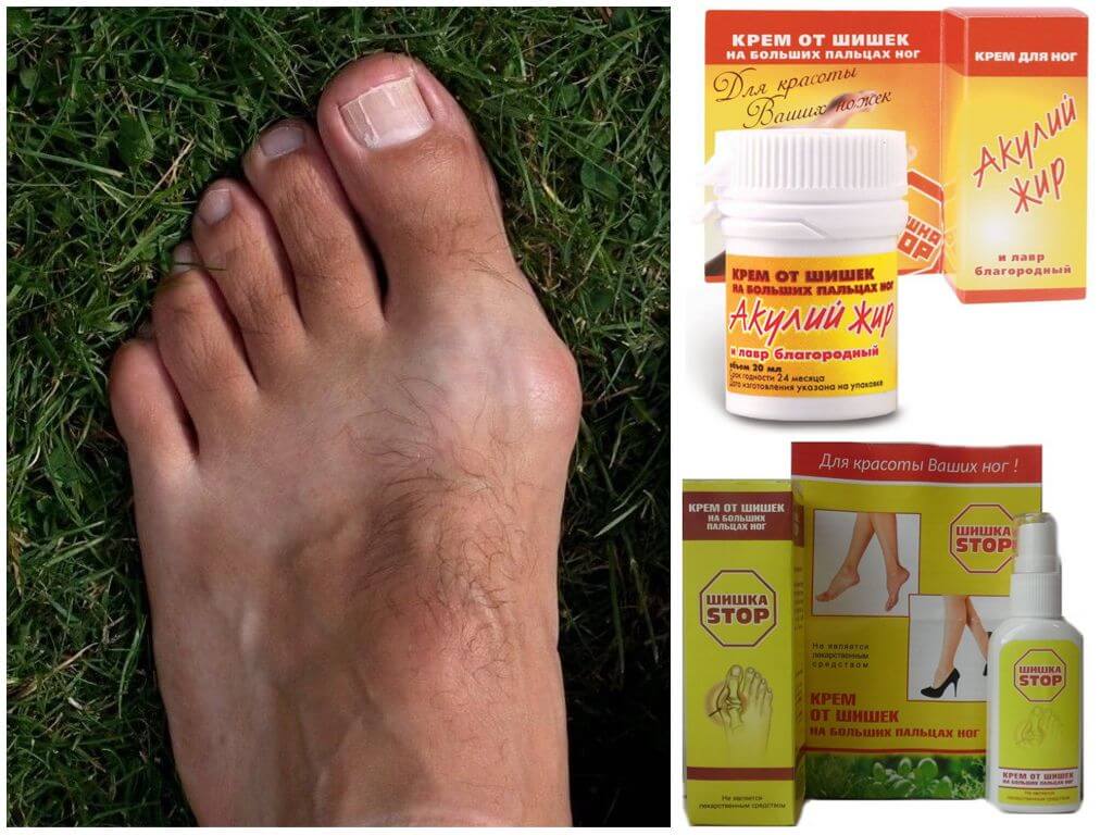 Крем Шишка Стоп от косточек на ногах