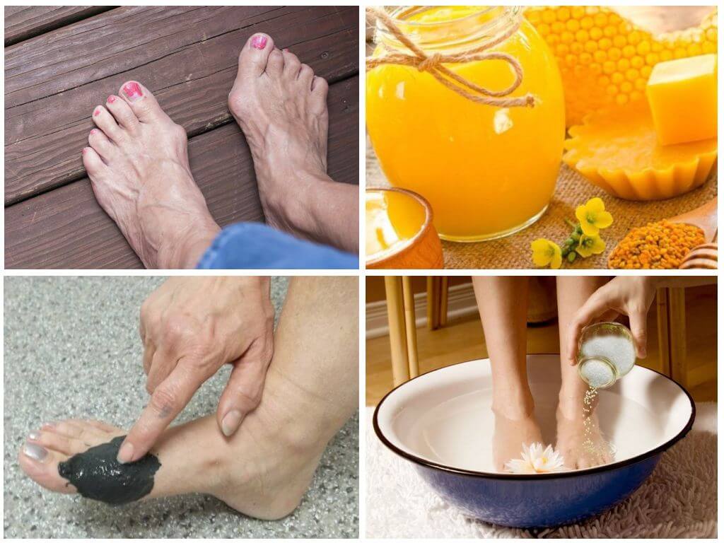 Народные средства для лечения косточки на ноге