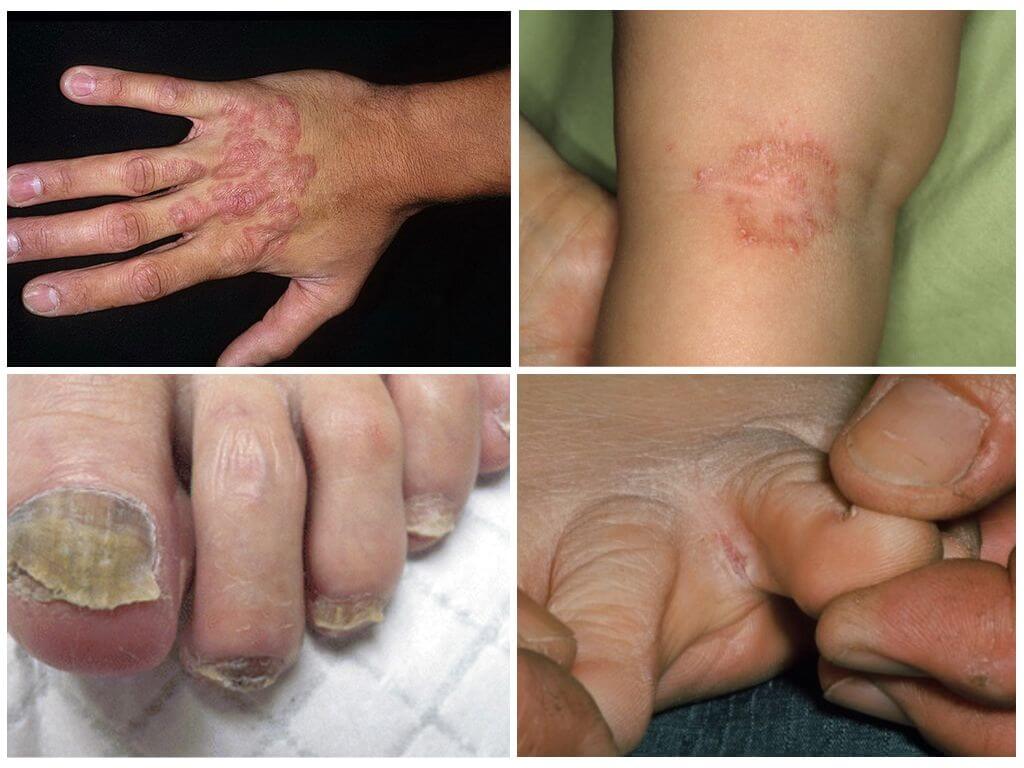 Показания к применению Тербинафина