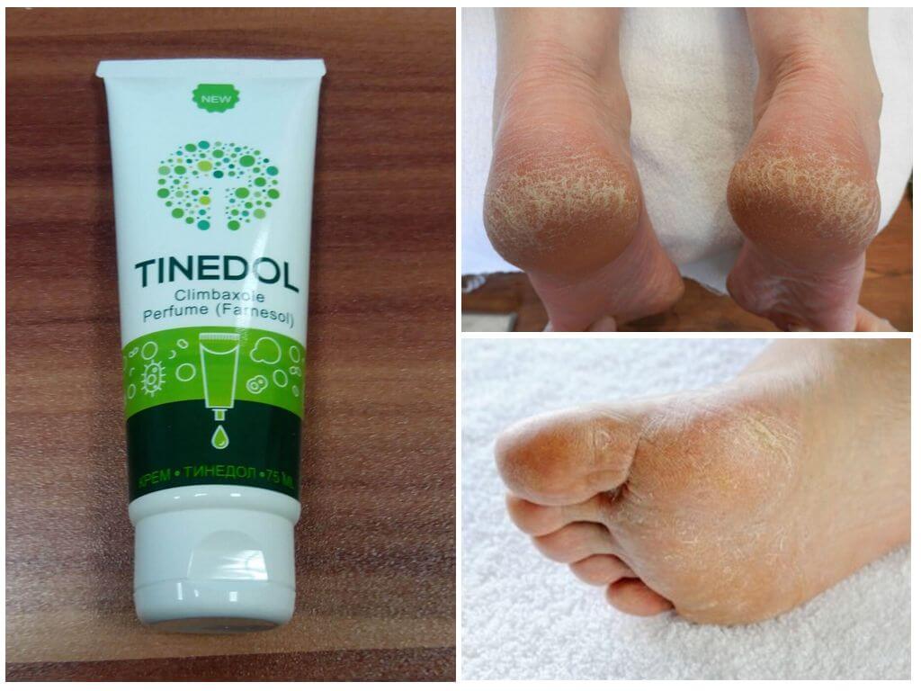 Показания к применению Тинедола