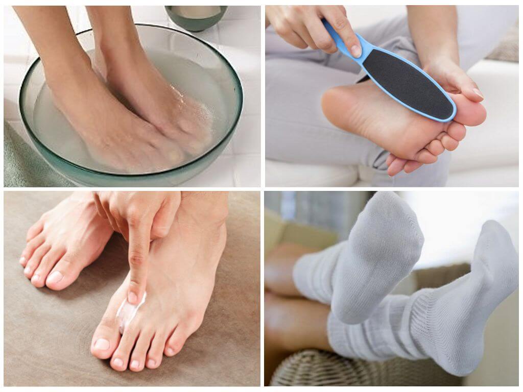 Уход за ногами перед применением Тинедола
