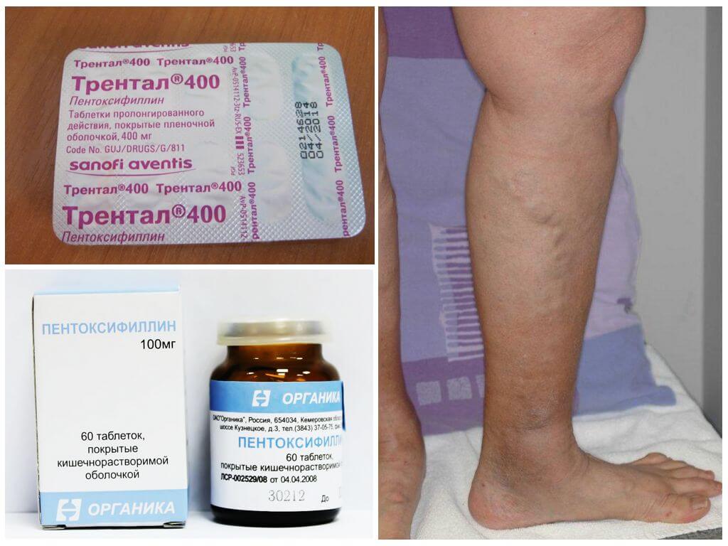 Трентал и Пентоксифиллин от варикоза