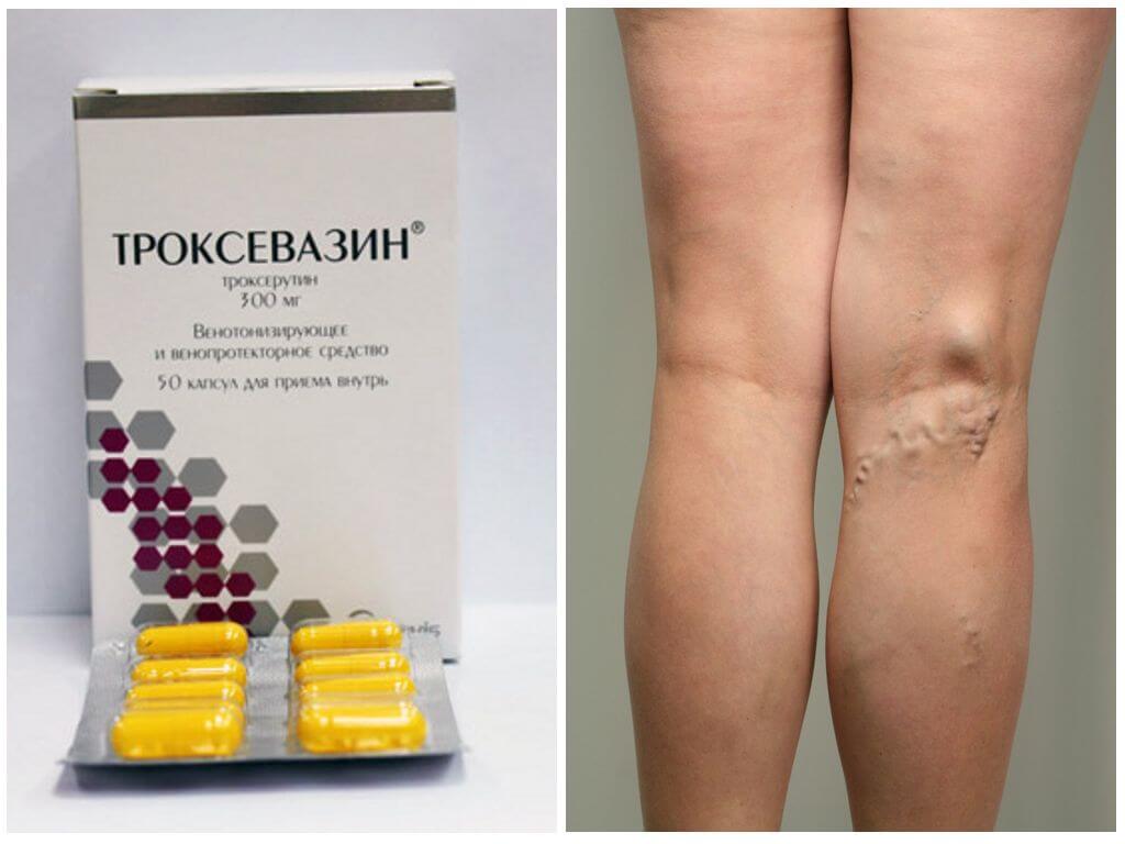 Троксевазин для лечения варикозного расширения вен