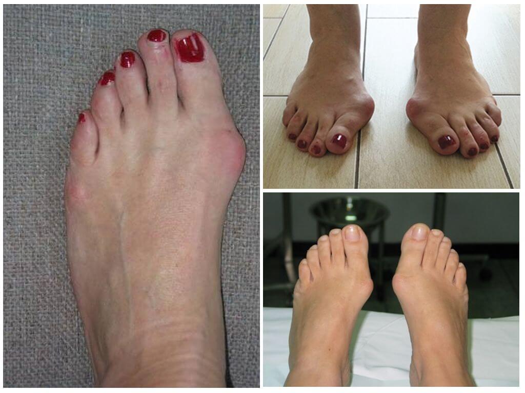 Косточка на большом пальце ноги