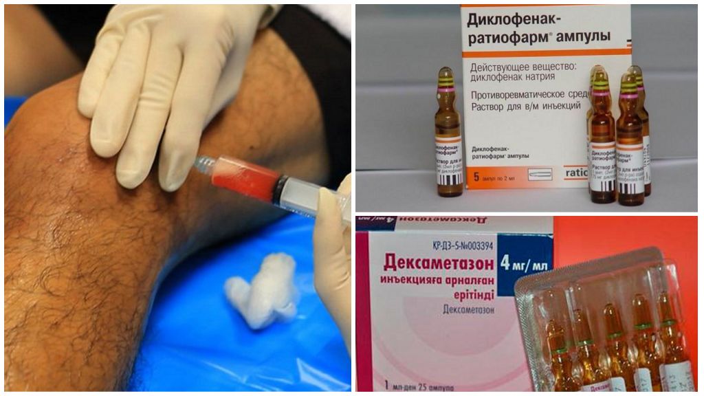 Инъекции при артрозе колена