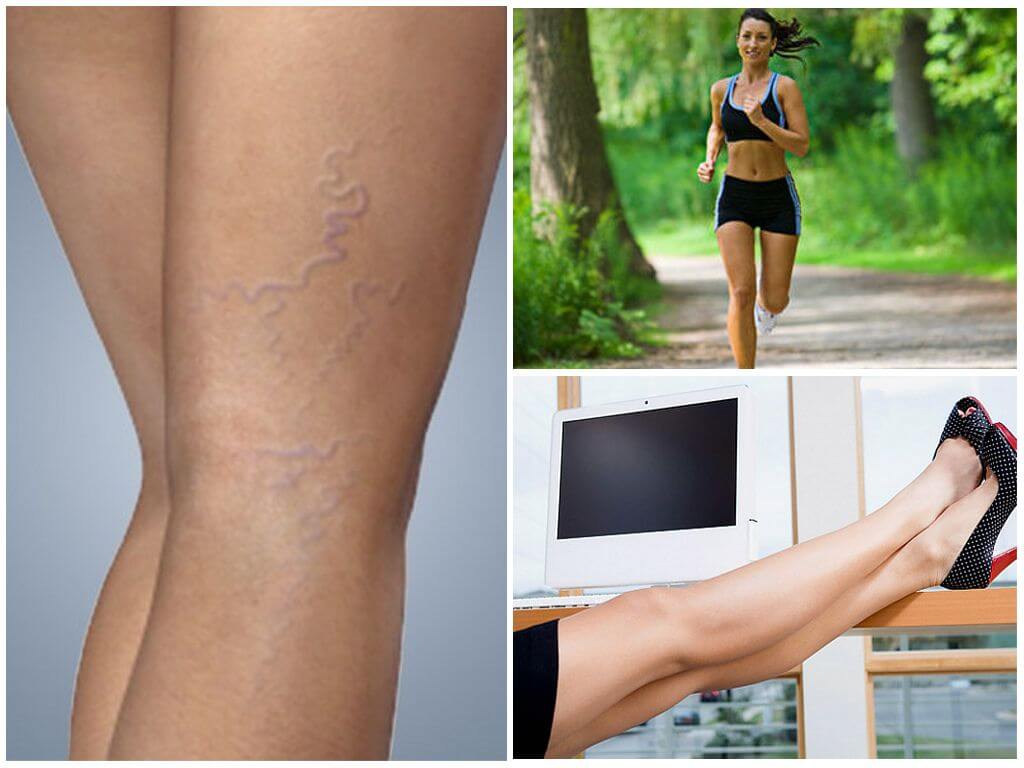 Профилактика варикозного расширения вен на ногах