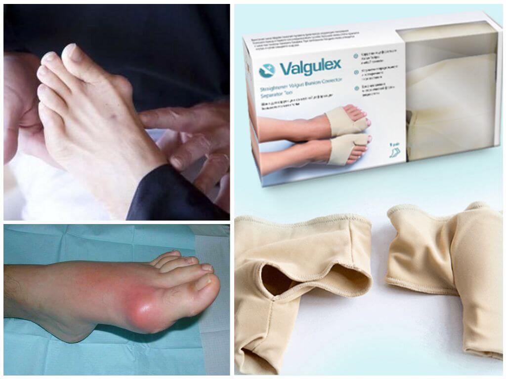 Эффективность корректора Вальгулекс