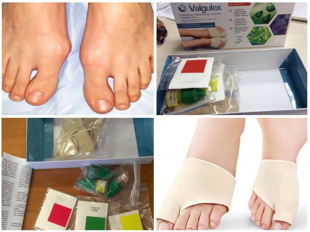 Лечение корректором Вальгулекс