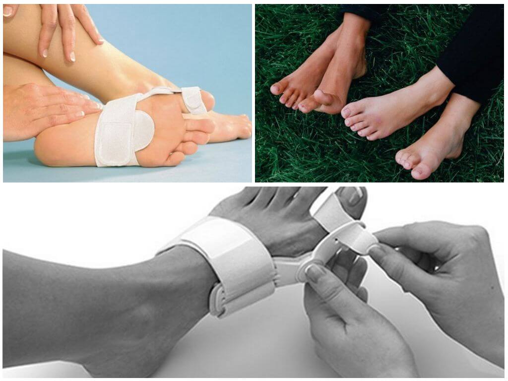 Эффективность фиксатора Валюфикс