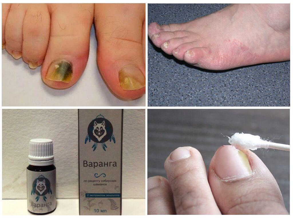 Использование средства от грибка Варанга