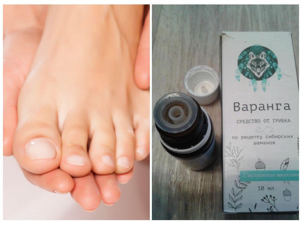 Варанга от грибка