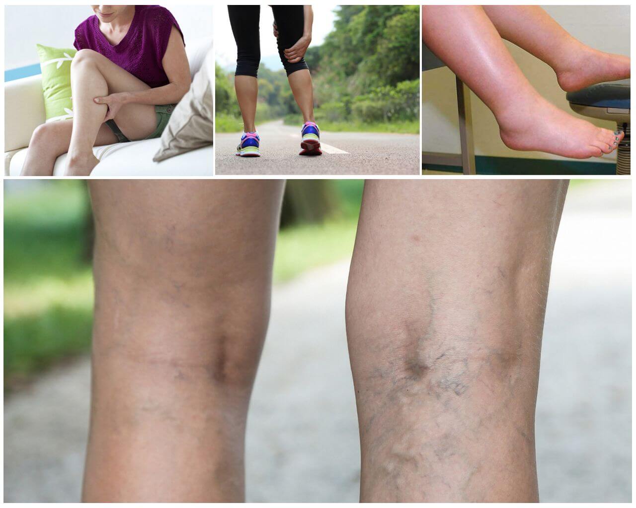 Симптомы варикоза вен нижних конечностей