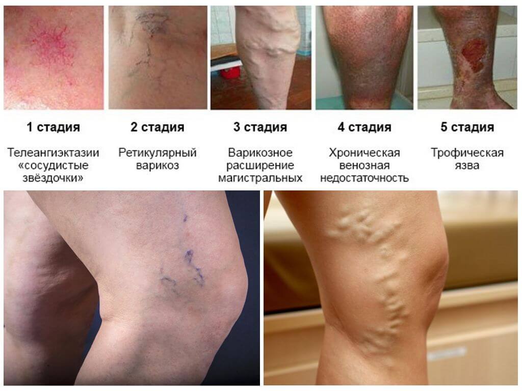 Стадии развития варикозы