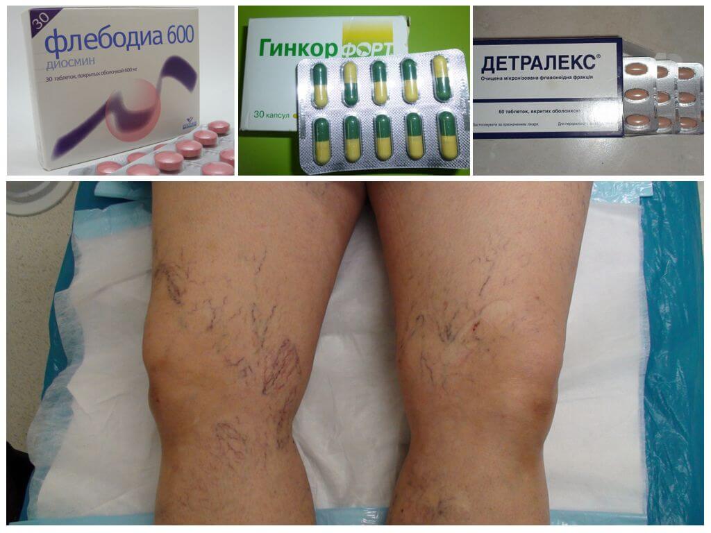 Таблетки при варикозе