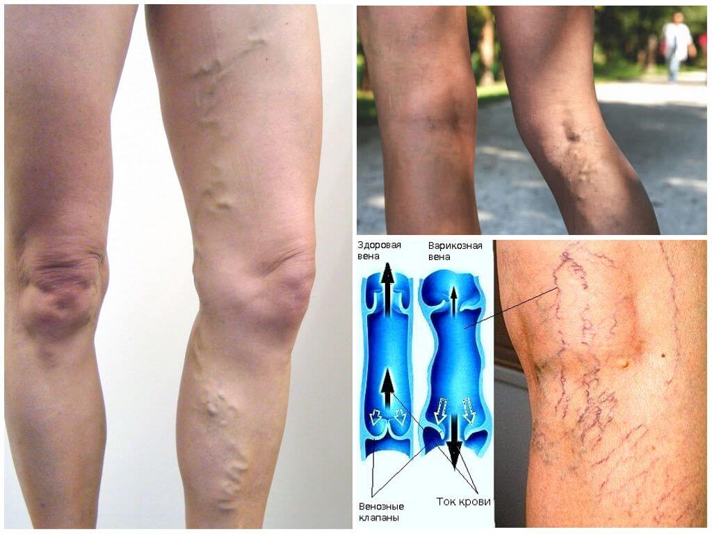 Варикоз вен на ногах