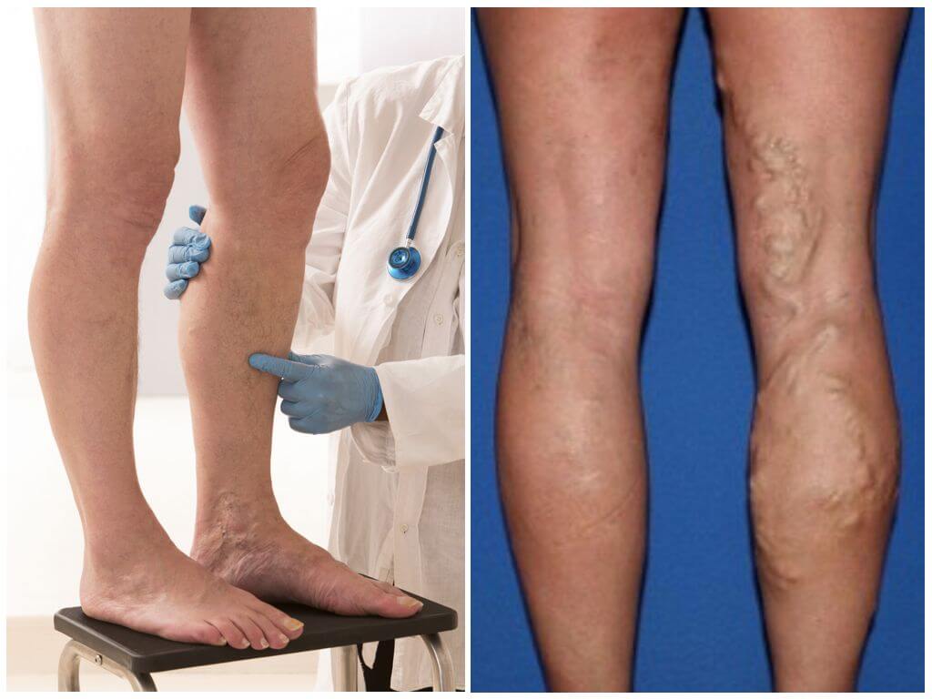 Варикозное расширение вен